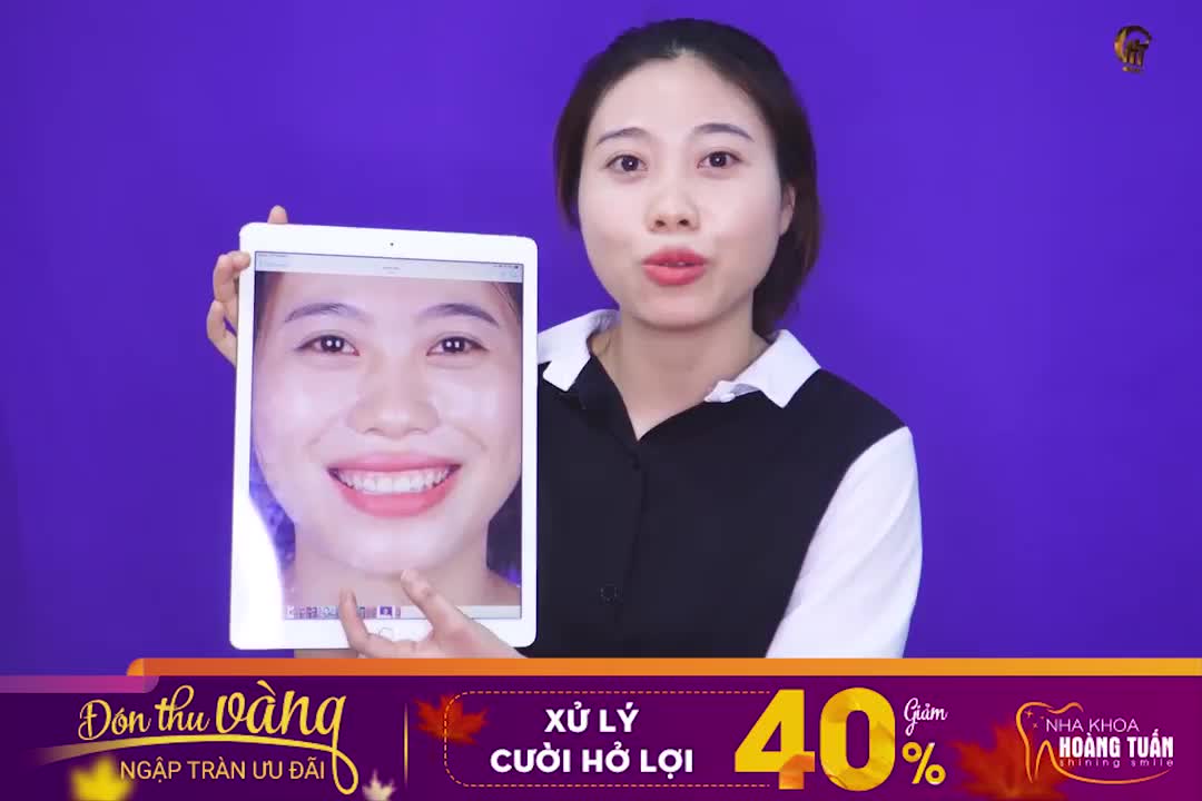 Chữa cười hở lợi chỉ 7.2 triệu TẶNG NGAY tẩy trắng miễn phí