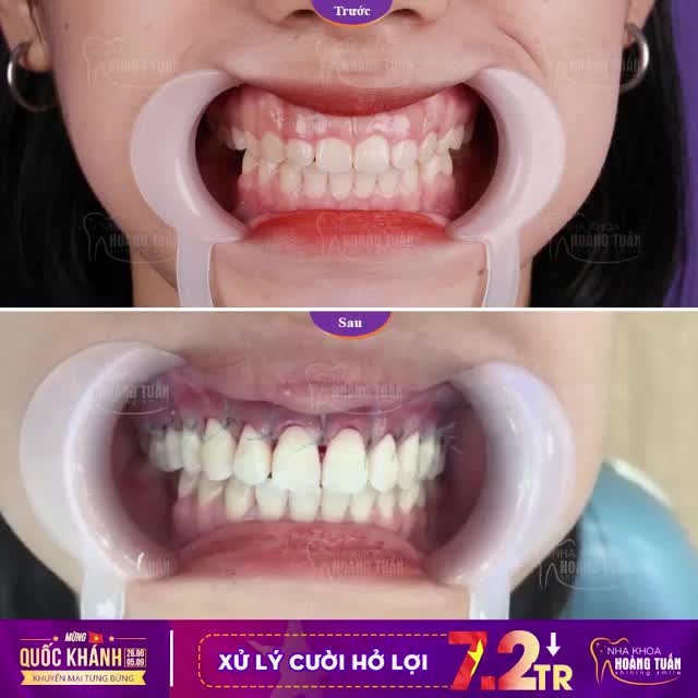 Hình ảnh ngay sau phẫu thuật lật vạt xử lý cười hở lợi
