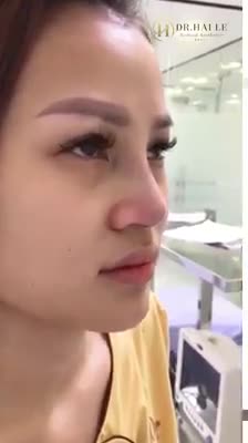 Biết nâng mũi đẹp mà không đau - ít sưng thế này đã làm từ sớm hơn!
Khách hàng của Dr.Hải Lê đang có ý định nâng mũi thì không nên bỏ qua video này nhé! Xem xong có động lực đến Dr.Hải Lê làm mũi luôn đó ạ!