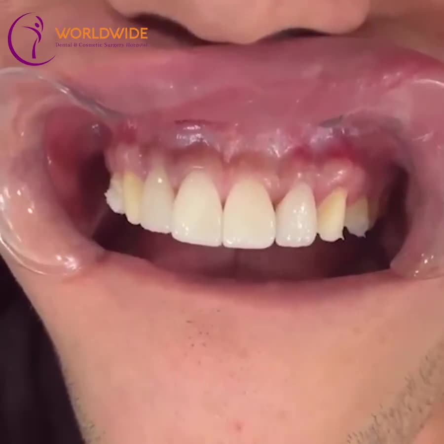 DÁN SỨ VENEER CÓ DỄ BONG TRÓC KHÔNG