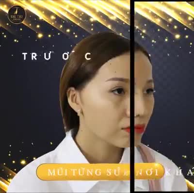 NÂNG MŨI A SHAPE: GIẢI PHÁP VÀNG TRONG "LÀNG" SỮA MŨI HỎNG
