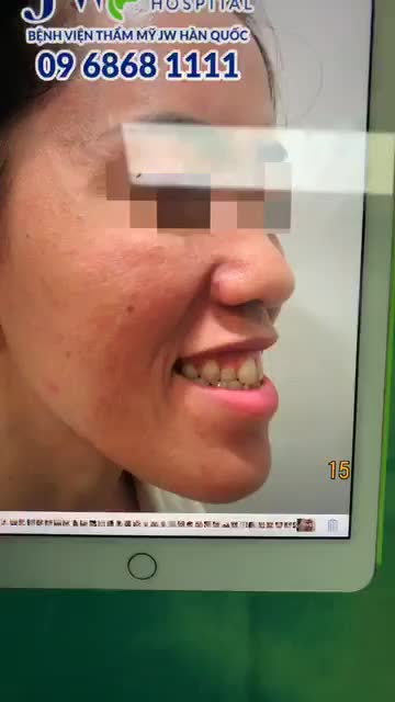 HÀM MÓM BIẾN DỊ, CÔ GÁI "CẦU CỨU" ĐẾN PHƯƠNG PHÁP PHẪU THUẬT BSSO HÀM DƯỚI