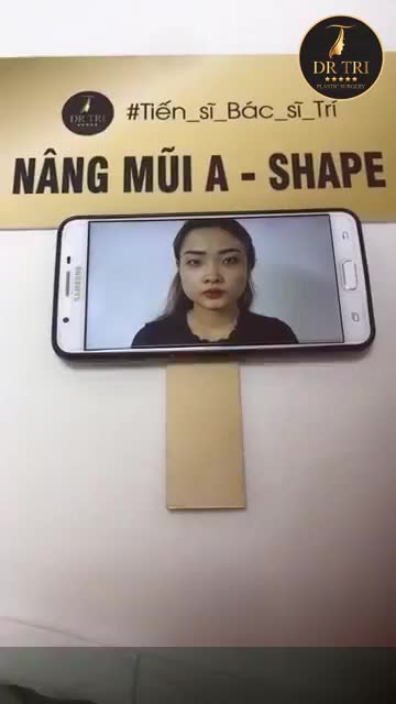 Kết quả sau phẫu thuật tạo hình mũi A Shape , tạo hình mí trên 2 tuần