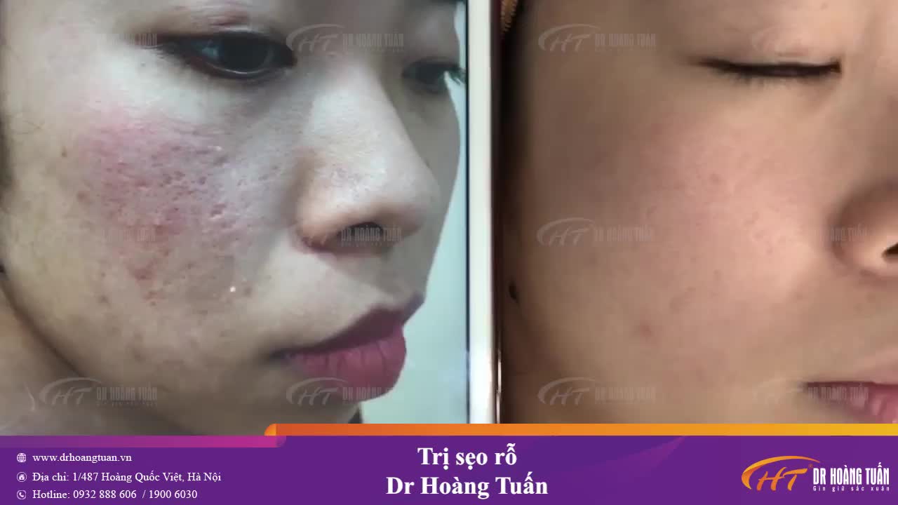 Điều trị sẹo rỗ an toàn và hiệu quả
