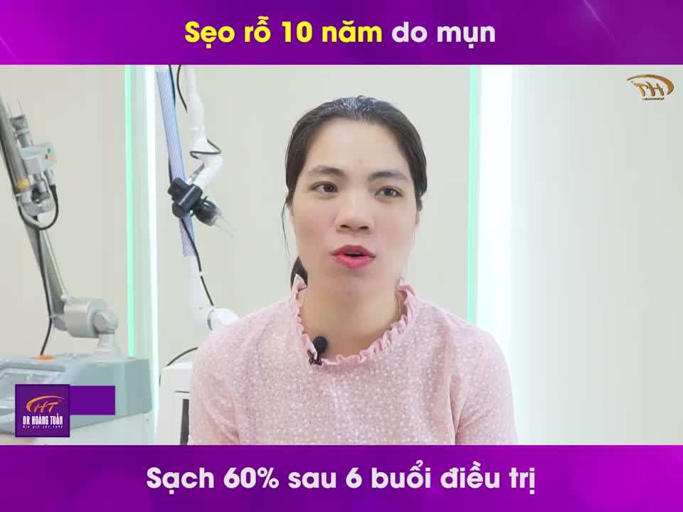 Chị Hằng thở phào nhẹ nhõm sau 6 buổi điều trị sẹo rỗ
