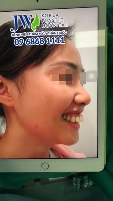 TỦI THÂN VÌ HÀM HÔ VÀ NỤ CƯỜI HỞ NƯỚU, CÔ GÁI TRẺ ĐÃ "CẦU CỨU" BỆNH VIỆN JW