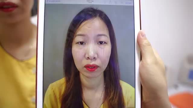 Bạn tự ti với đôi mắt một mí