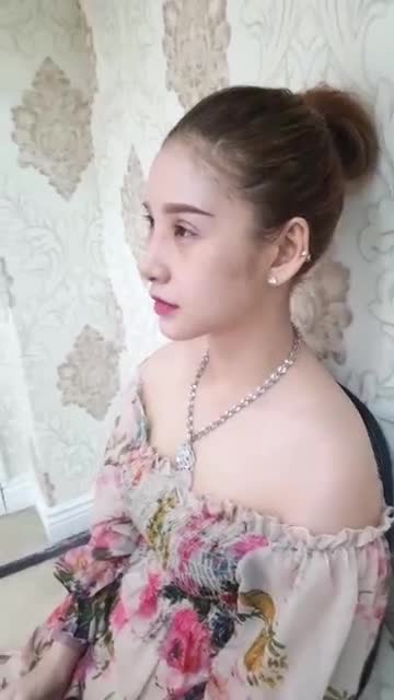 Nâng mũi Sline bọc sụn bọc cân, độn cằm sau 10 ngày