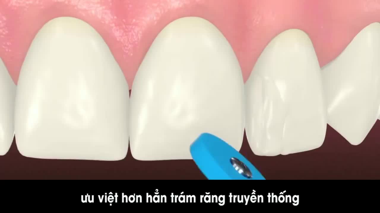 TRÁM RĂNG THẨM MỸ CÔNG NGHỆ HALOGEN