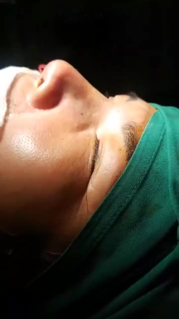 Nâng mũi bán cấu trúc 2 lớp