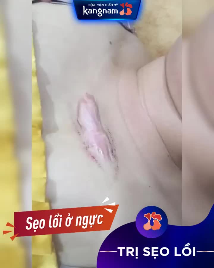 Trị SẸO LỒI ở ngực bằng nhiều PP không cải thiện, thậm chí lan rộng hơn trước