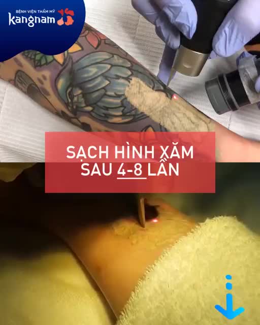 LÀM THẾ NÀO ĐỂ XÓA XĂM - KHÔNG ĐỂ LẠI SẸO?