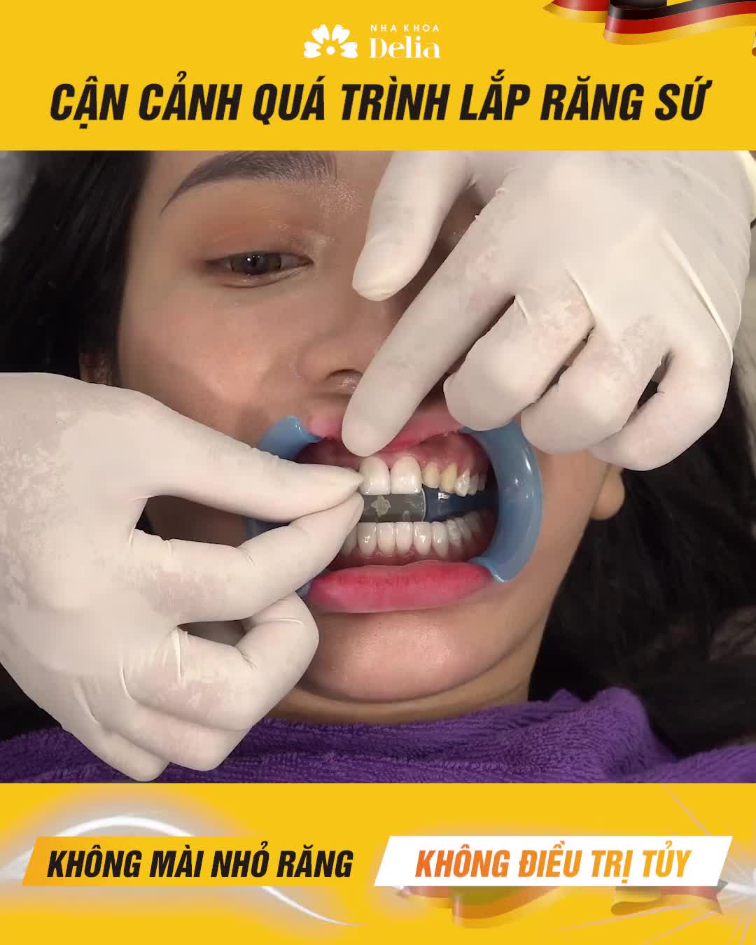 DÁN SỨ VENEER TIÊU CHUẨN ĐỨC - KHÔNG MÀI RĂNG