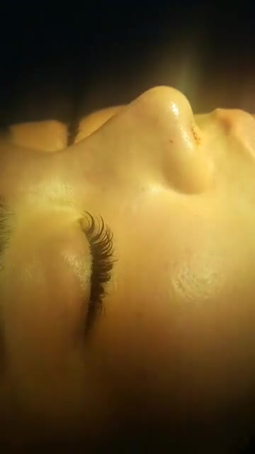 Nâng mũi sụn tai 2 lớp