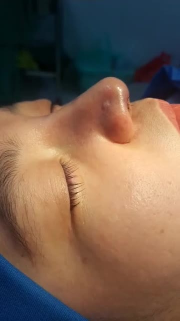 Nâng mũi sụn tai 2 lớp