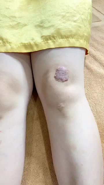 ĐIỀU TRỊ SẸO LỒI VỚI CÔNG NGHỆ ÁNH SÁNG ELLA - CẢI THIỆN CHỈ SAU 1 LẦN