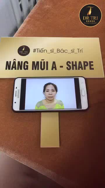 Kết quả sau phẫu thuật tạo hình mũi A Shape 2 tuần