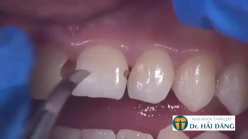 Hàn trám răng công nghệ cao