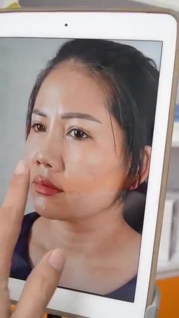 KẾT QUẢ SAU 1 THÁNG NÂNG MŨI + CĂNG DA THÁI DƯƠNG ĐẸP, AN TOÀN