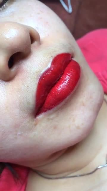 kết quả phun môi collagen