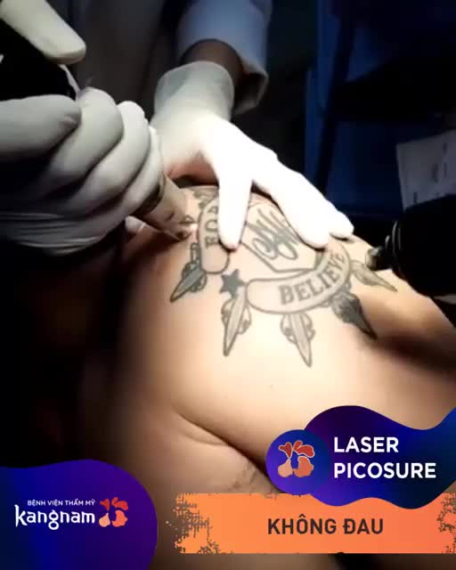 LASER PICOSURE - Đánh bật mọi HÌNH XĂM ĐẬM MÀU