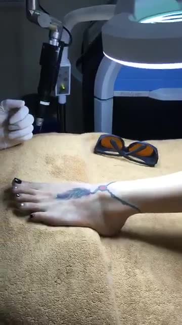 Xoá xăm triệt để bằng công nghệ Laser Picosure tại BVTM Kangnam