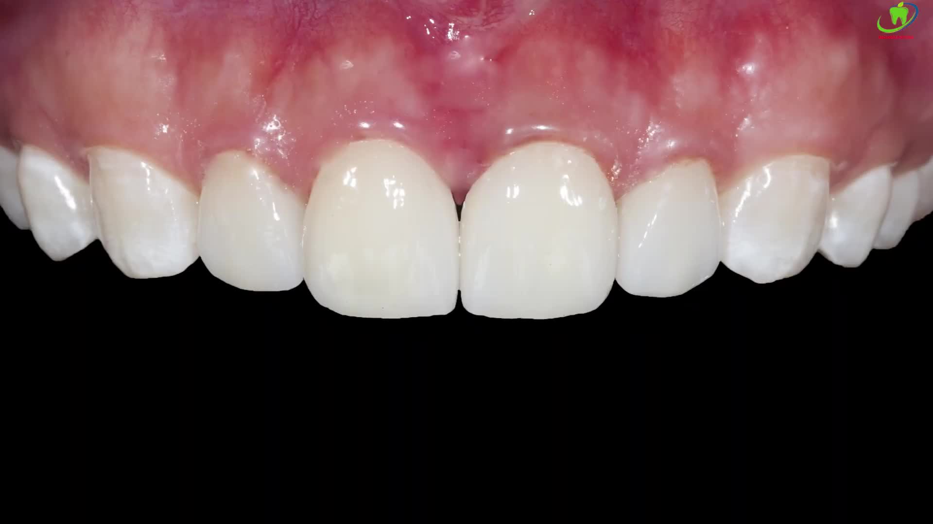 DÁN SỨ MỘT LẦN KẾT QUẢ VĨNH HẰNG
