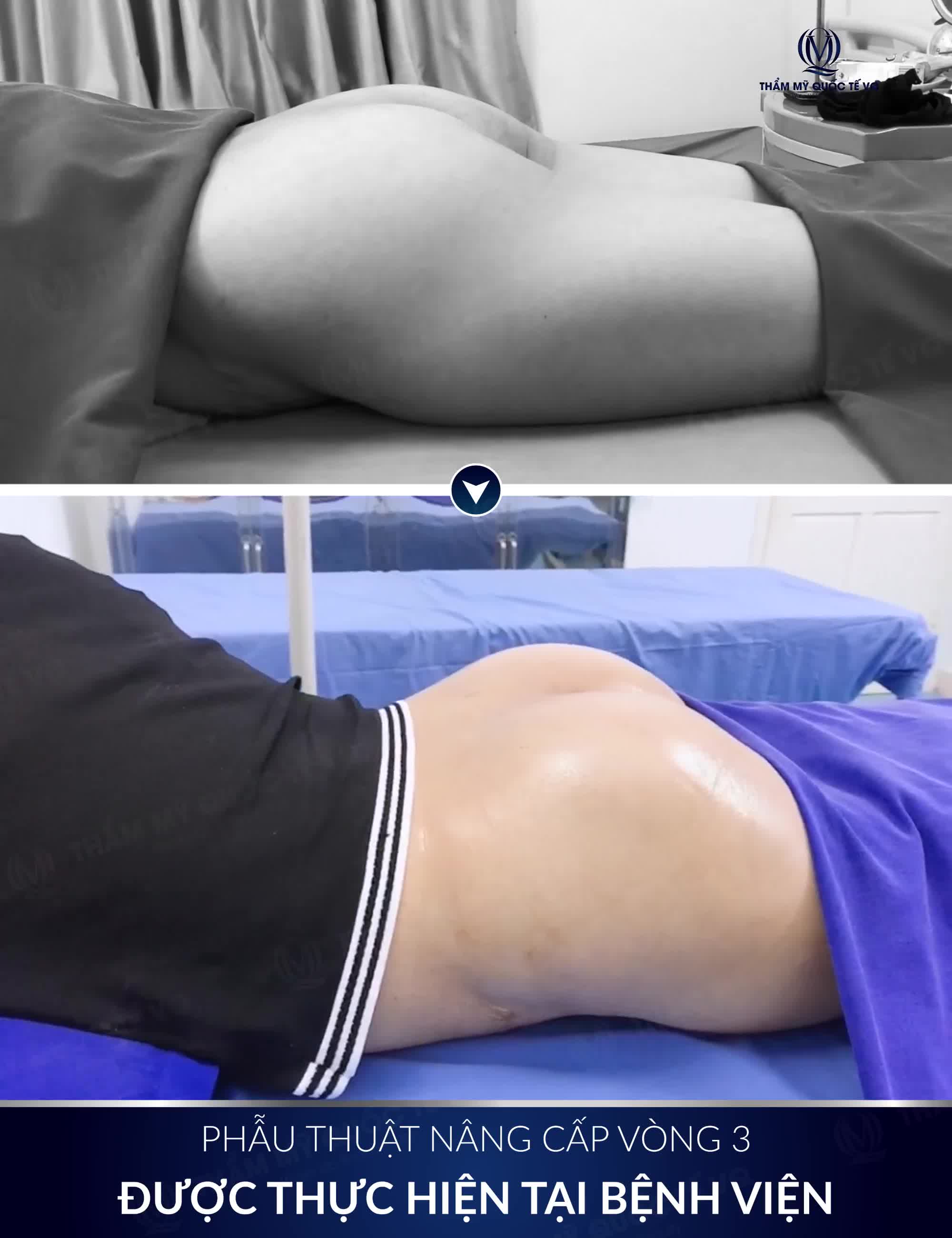 NÂNG CẤP VÒNG 3 VỚI TÚI ĐỘN MOTIVA