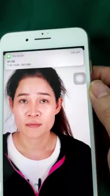 Nâng mũi Sform Plus cân thái dương dành cho mũi sửa lại