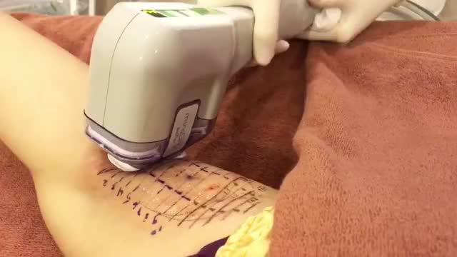 CÙNG XEM QUÁ TRÌNH ĐIỀUTRỊ CHỨNG TĂNG TIẾT MỒ HÔI NÁCH DOUBLE MIRADRY