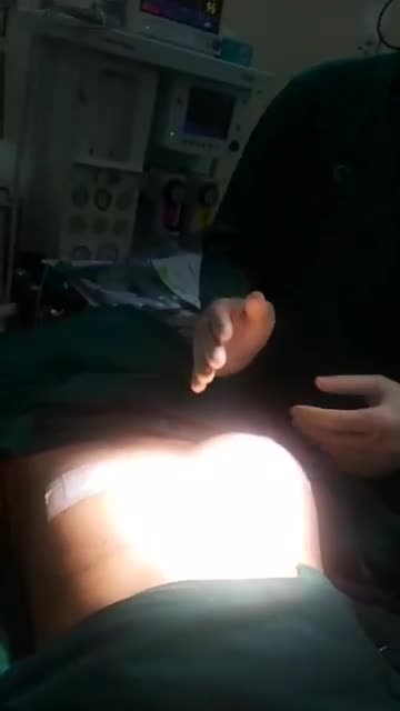 Nâng ngực nội soi chân không vừa xong 1 bên nè cả nhà.