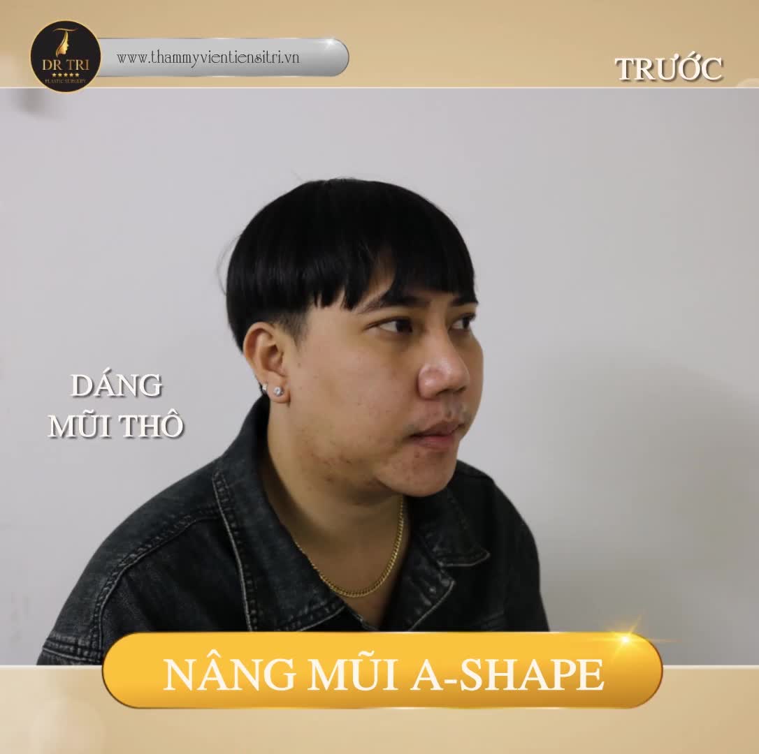 NHAN SẮC TĂNG VỌT SAU KHI NÂNG MŨI A SHAPE