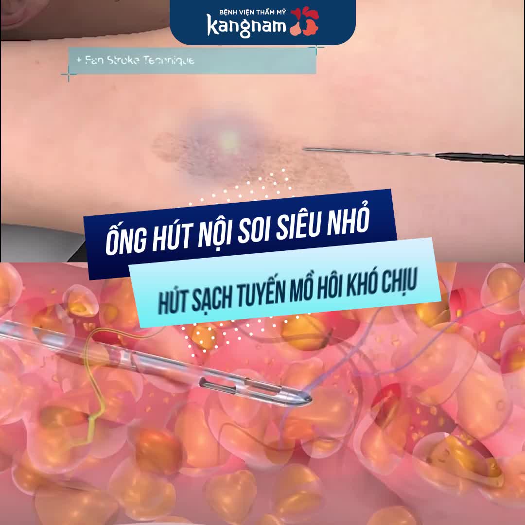 TRỊ HÔI NÁCH VĨNH VIỄN VỚI ENDO DRY