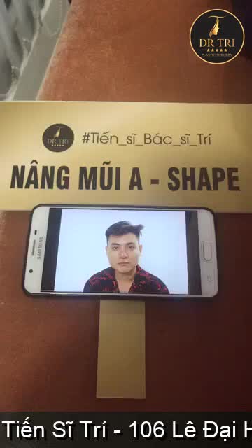 Kết quả sau phẫu thuật tạo hình mũi A Shape Nam 2 tuần đã từng làm mũi ở nơi khác