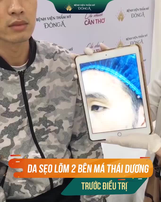 Thay đổi Kinh ngạc sau 1 lần trị sẹo rỗ của chàng trai đến từ Cần Thơ: Da đều màu, sáng mịn