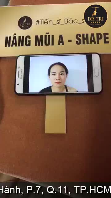 Mời các bạn đón xem kết quả sau 7 ngày phẫu thuật nâng_mũi_A_Shape của khách hàng tại Dr_Trí!