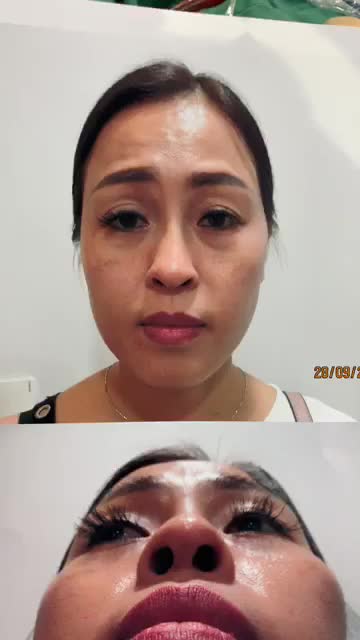 TÁI PHẪU THUẬT SIÊU DÁNG MŨI S LINE CHO TRƯỜNG HỢP MŨI LỘ SÓNG