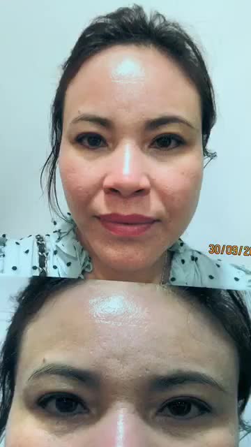 "VẼ LẠI NẾP MÍ" CHO NỮ KHÁCH HÀNG BỊ SỤP MÍ