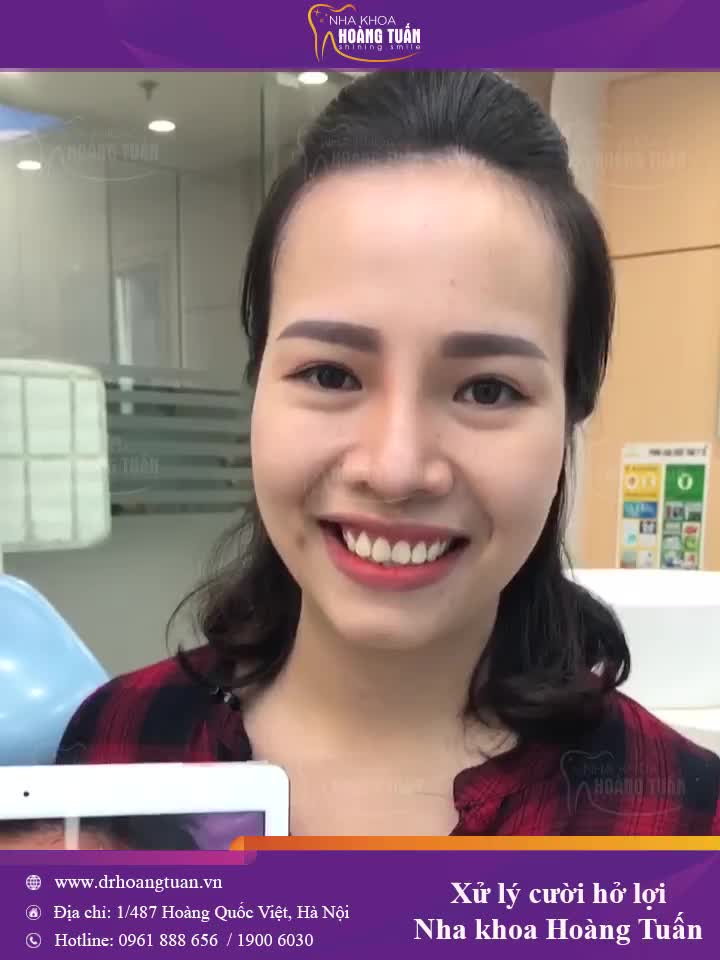 CHỮA CƯỜI HỞ LỢI - GIẢI PHÁP CHO NỤ CƯỜI HOÀN HẢO