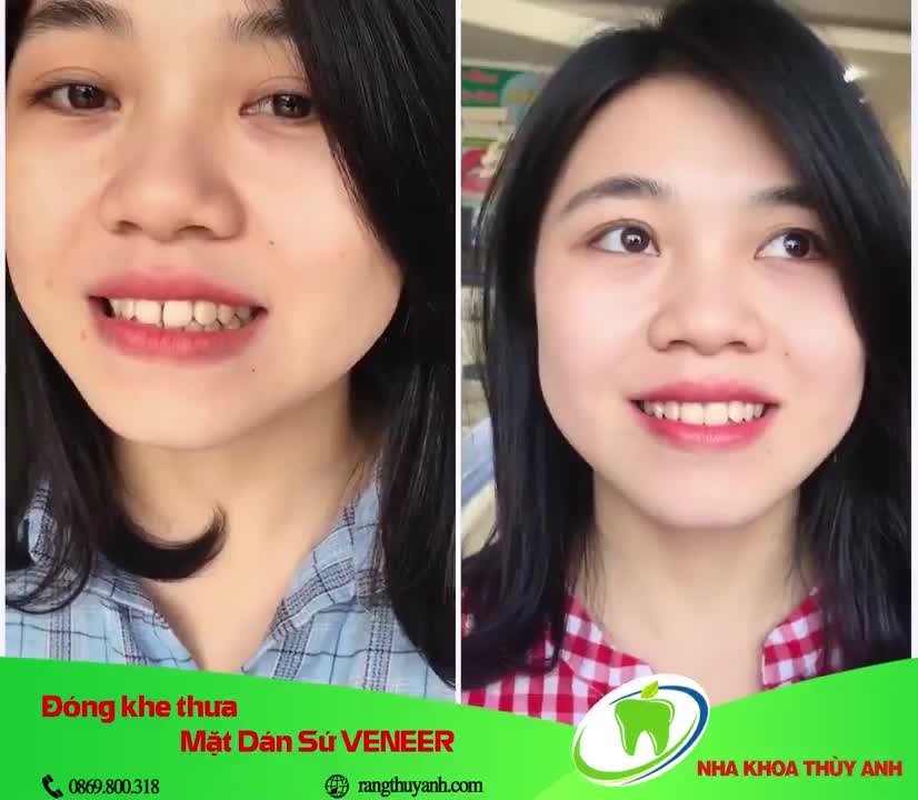 DÁN SỨ VENEER - BÍ KÍP SỞ HỮU NỤ CƯỜI RẠNG RỠ