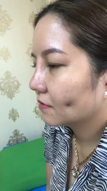 Tái khám cắt chỉ Combo Nâng mũi Cấu Trúc Sụn Tai và Tạo má lúm đồng tiền duyên