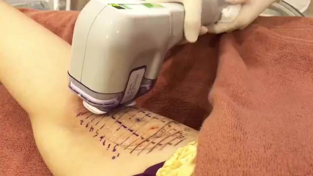 CÙNG XEM QUY TRÌNH ĐIỀU TRỊ CHỨNG TĂNG TIẾT MỒ HÔI NÁCH DOUBLE MIRADRY