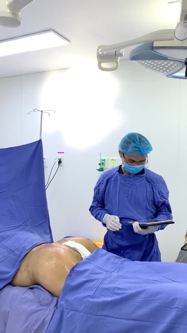 Kết quả nâng mông bằng mỡ tự thân cho khách hàng