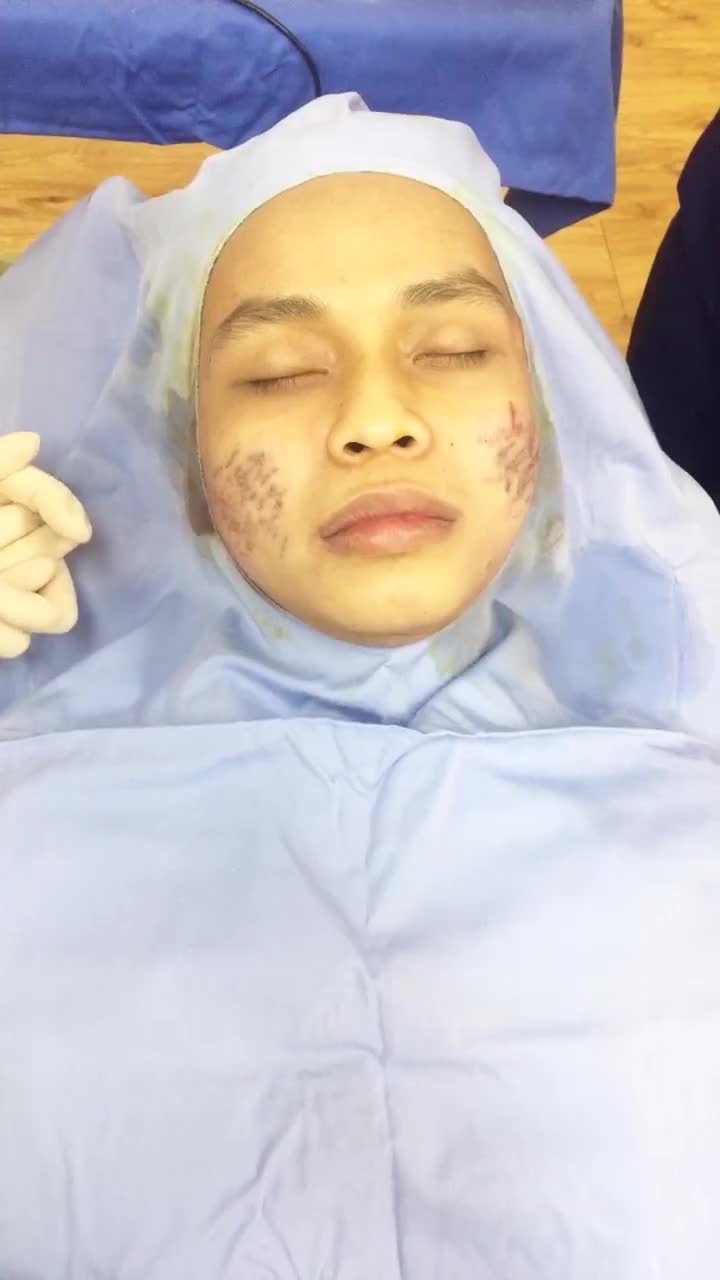 Phi kim vi điểm điều trị sẹo lõm bằng CN Bio Scar