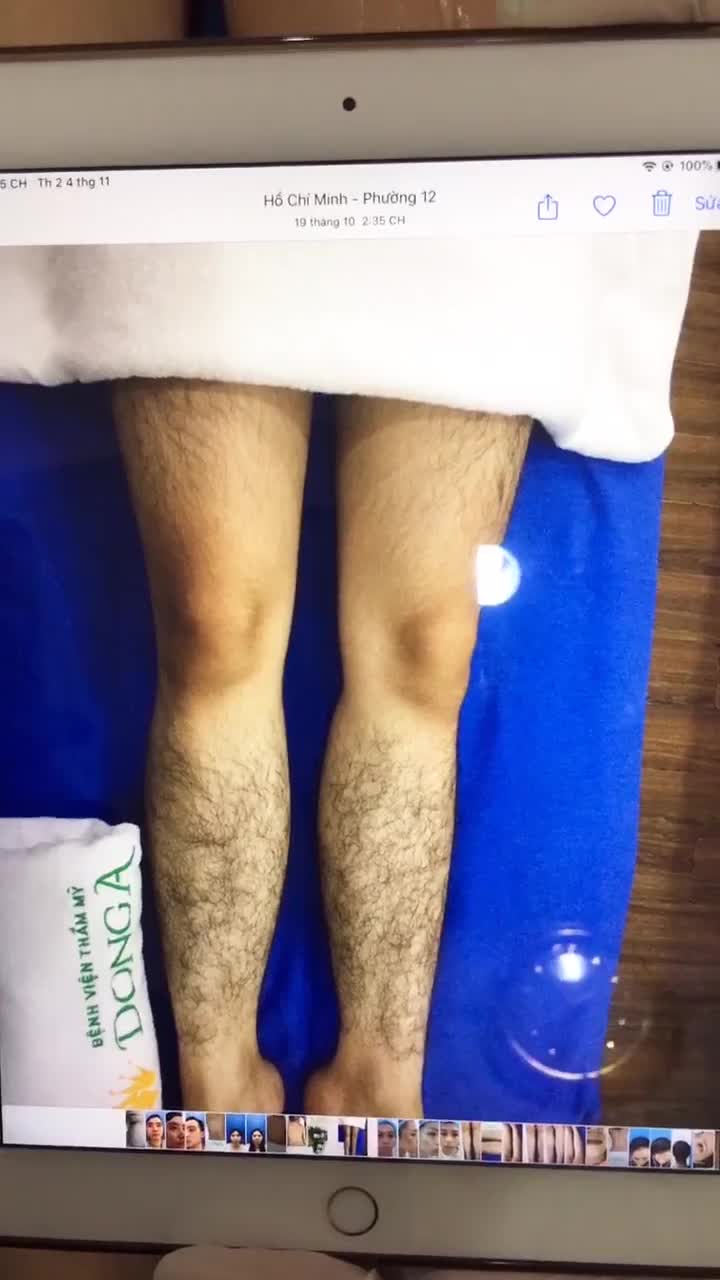 Sạch tới 99% lông mọi phân vùng với CN Triệt lông Diode Laser