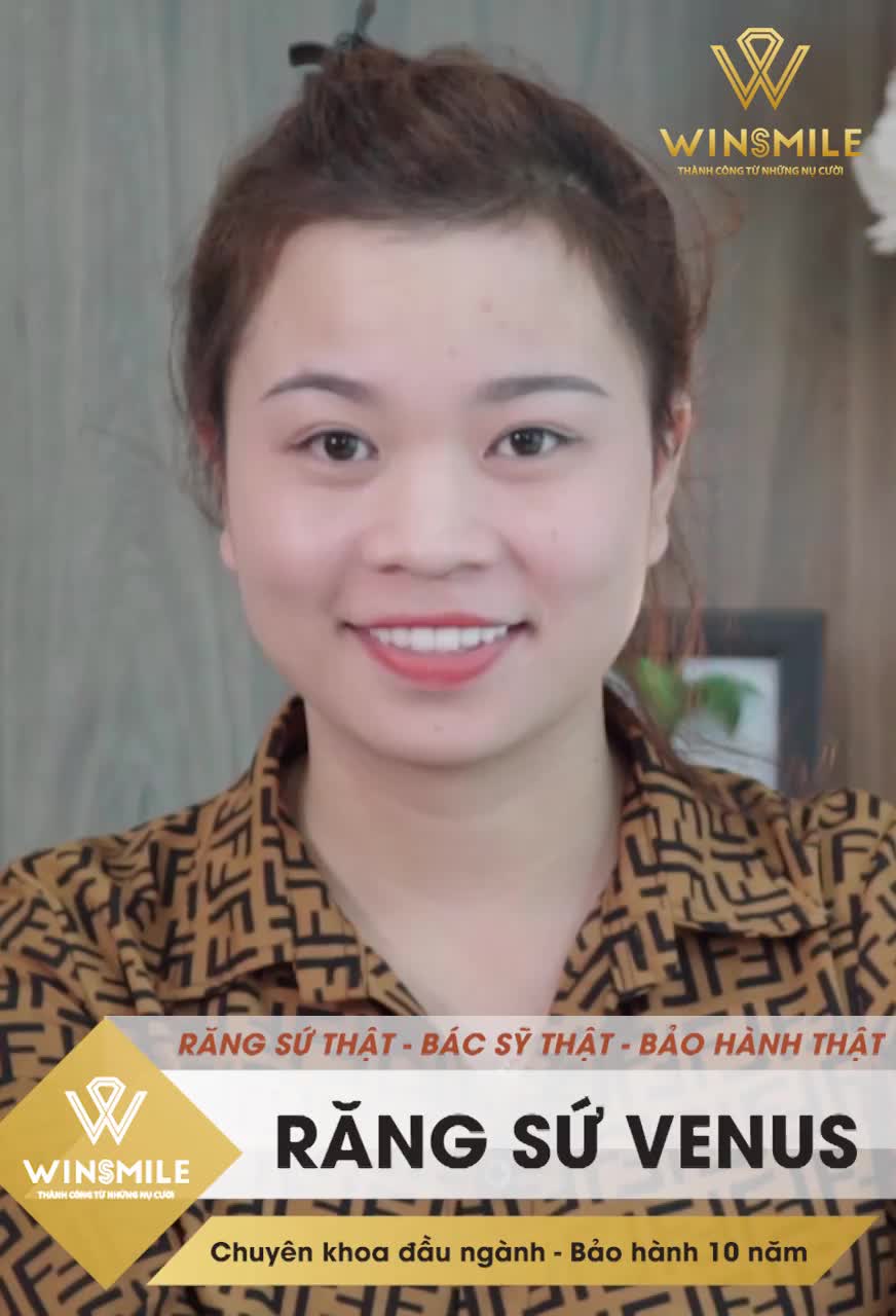 BỌC RĂNG SỨ VENUS CÓ TỐT KHÔNG