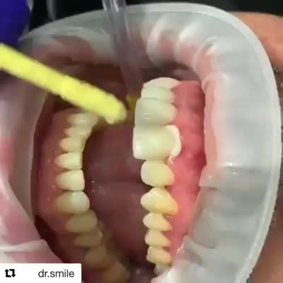 Hình ảnh dán Veneer