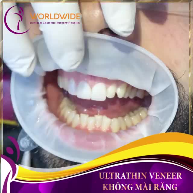 ULTRATHIN VENEER
