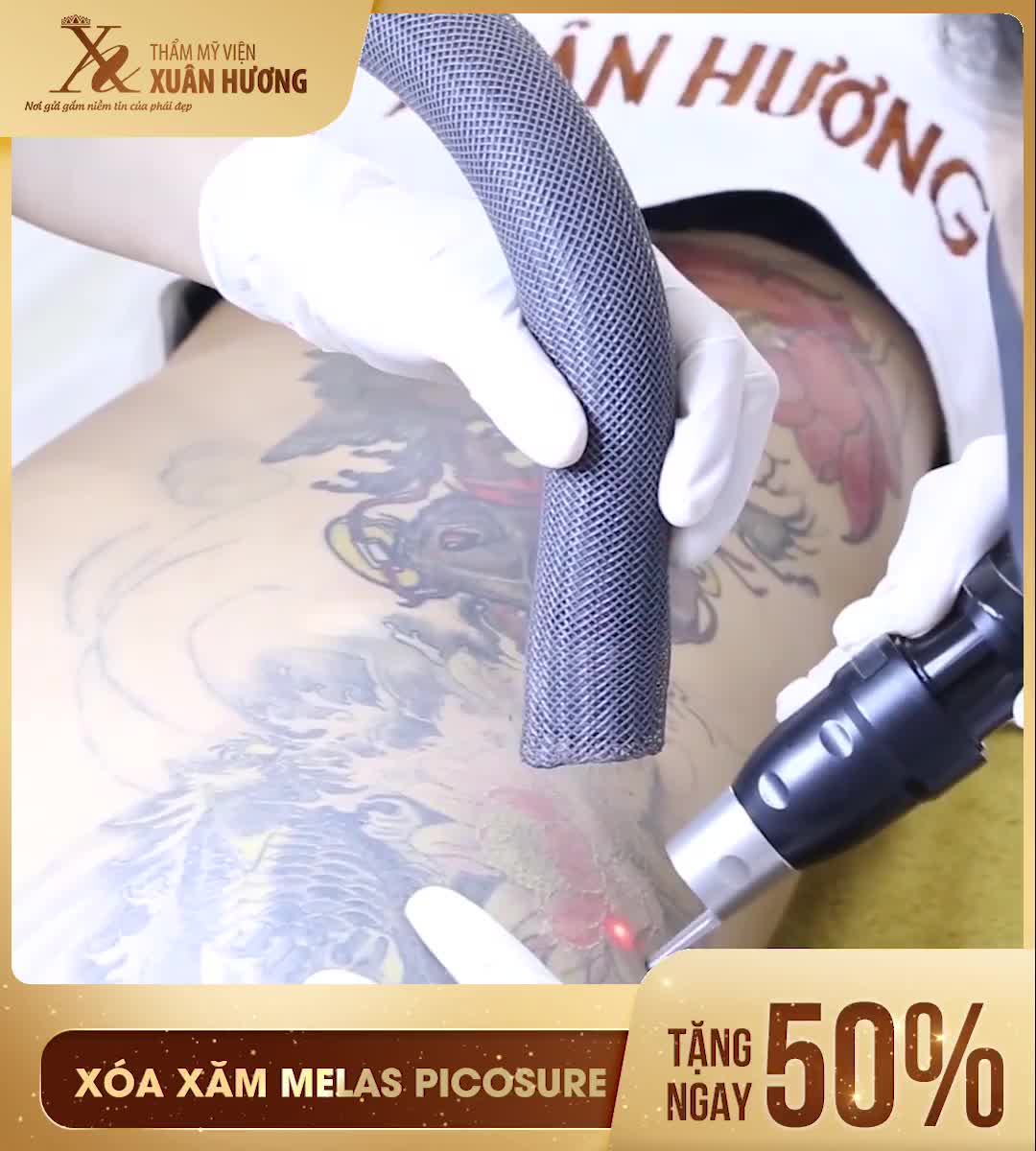 HÌNH XĂM KHÓ XÓA ĐẾN ĐÂU CŨNG BỊ HẠ GỤC BỞI MELAS PICOSURE