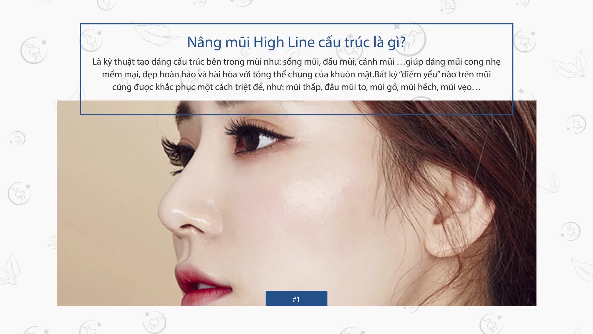 NÂNG MŨI HIGH LINE CẤU TRÚC - ĐỈNH CAO CÔNG NGHỆ NÂNG MŨI